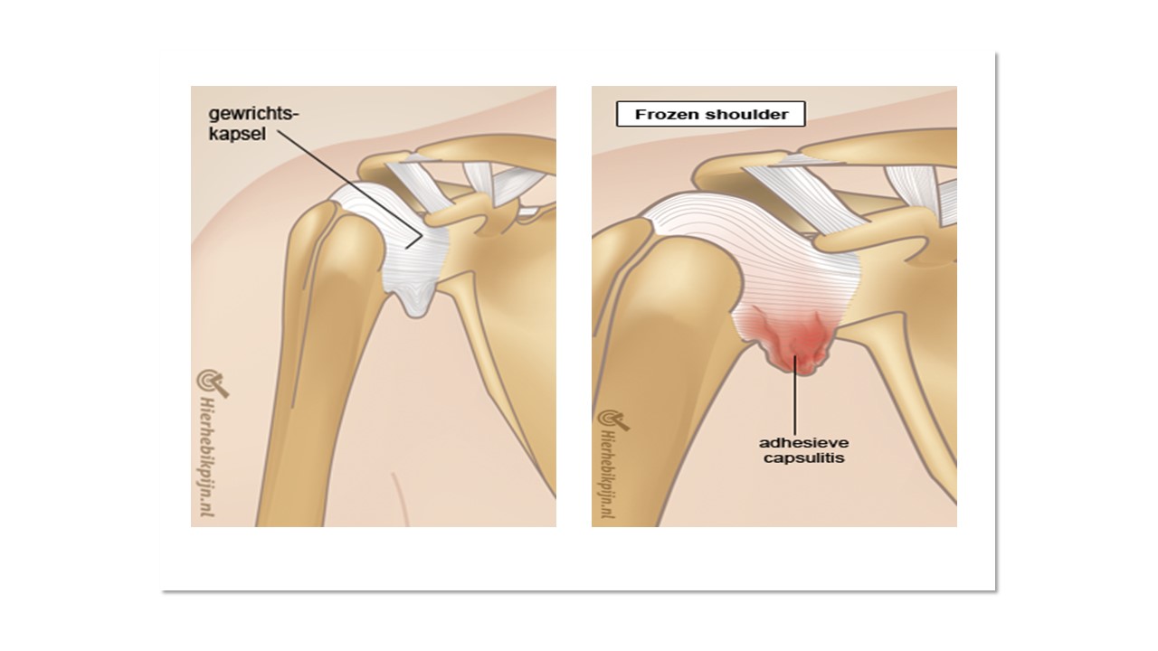 Frozen shoulder de oorzaak